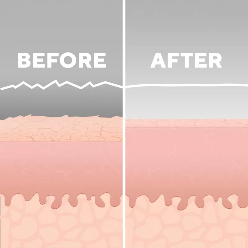 HoMedics MD-1000-EU2 huidverzorgingsapparaat huidvacuüm-microdermabrasie wit