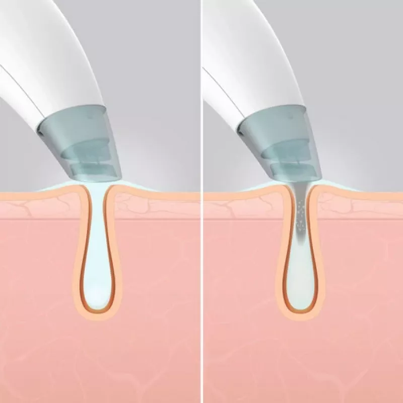 HoMedics FAC-HY100 huidverzorgingsapparaat hydradermabrasion-reiniger transparant, wit
